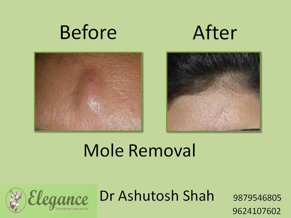Mole Removal Treatment, Bardoli, Gujarat, India.