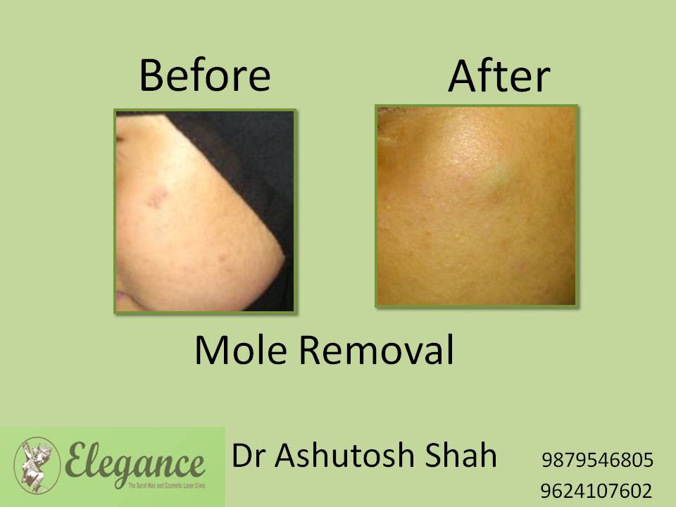 Mole Removal Treatment, Bilimora, Gujarat, India.
