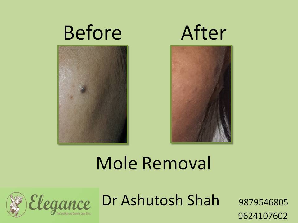 Mole Removal Treatment, Chhota Udaipur, Gujarat, India.