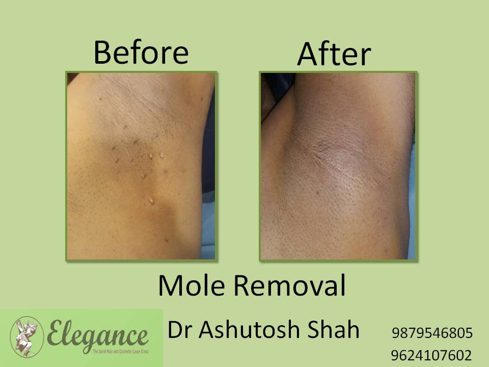 Mole Removal Treatment, Kim, Gujarat, India.