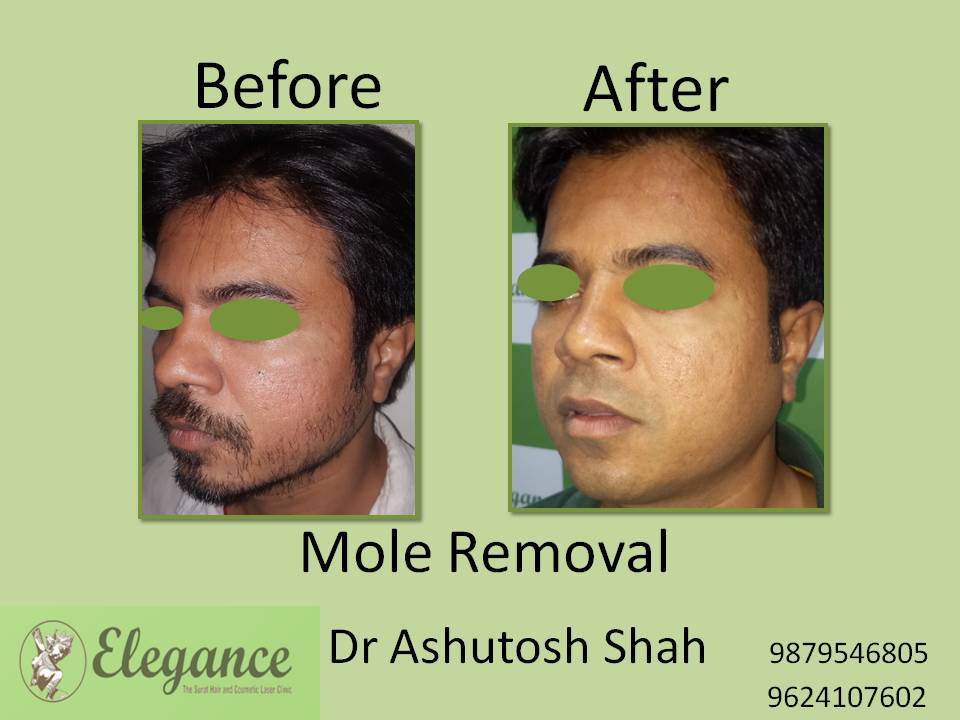 Mole Removal Treatment, Selvasa, Gujarat, India.
