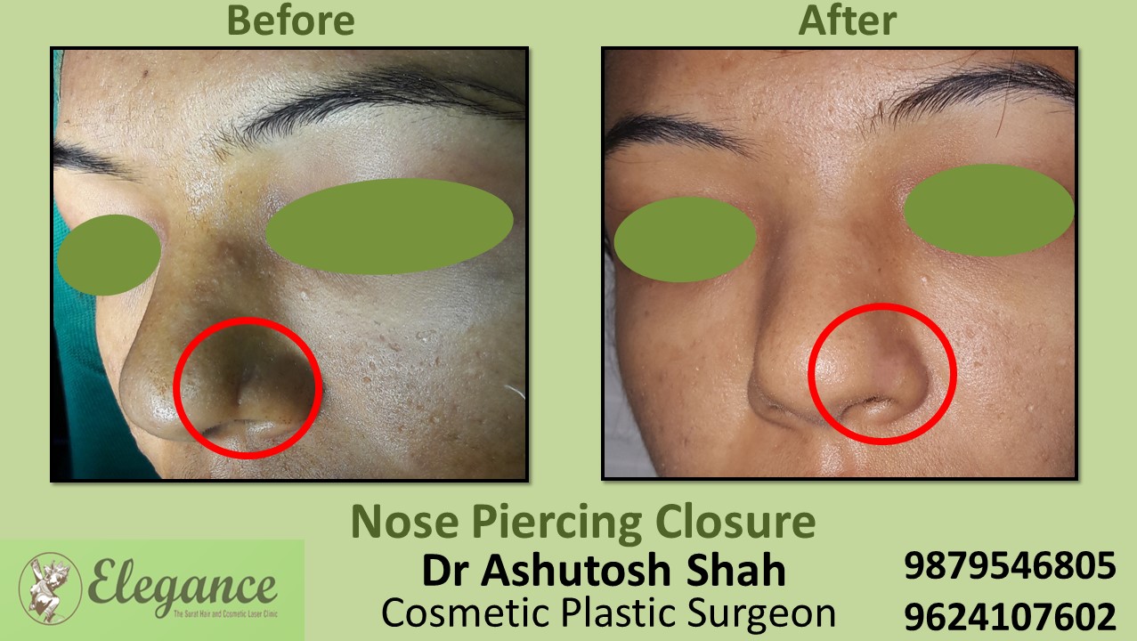 Nose piercing closure in Piplod, Athwalines, Adajan, Surat