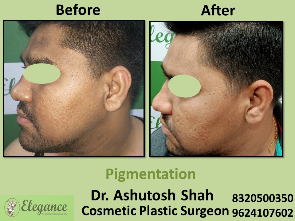 Pigmentation Correction Treatment in Adajan, Palanpur, Surat