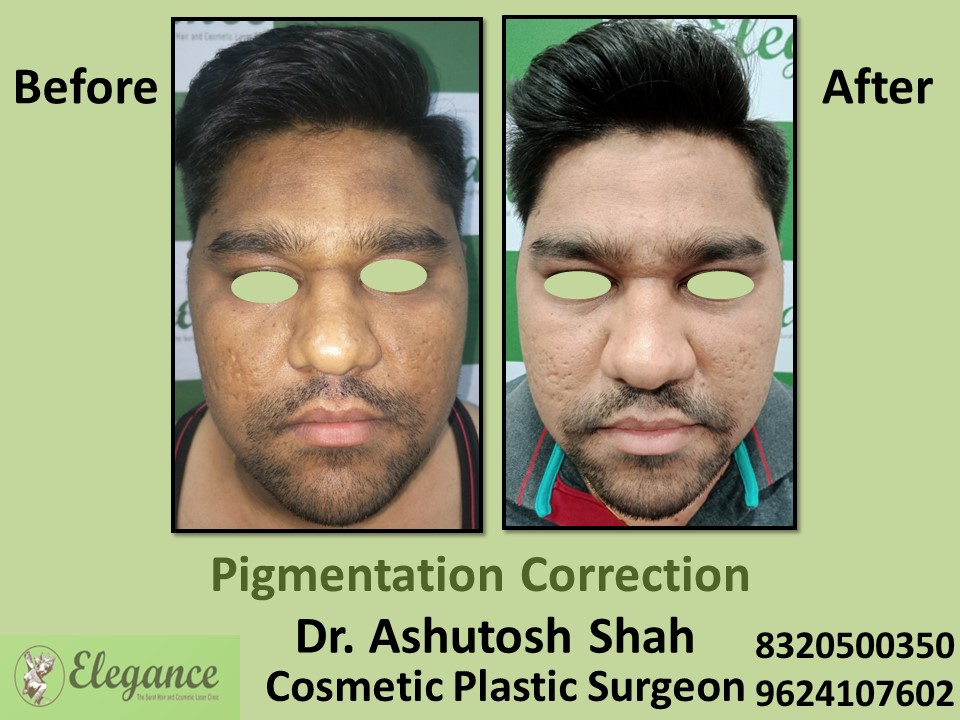 Pigmentation Correction Treatment in Adajan, Surat