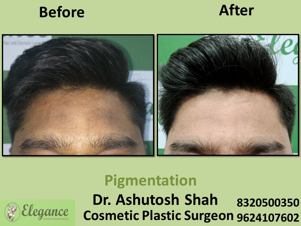 Pigmentation Correction Treatment in Adajan
