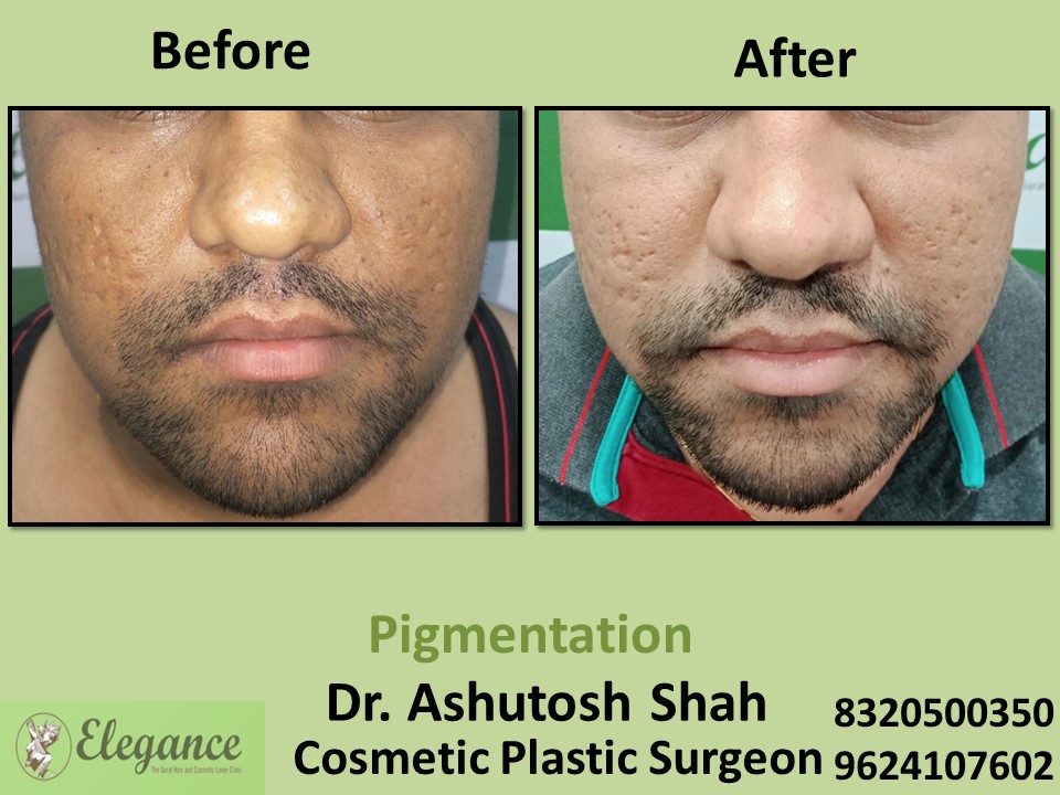 Pigmentation Correction Treatment in Athwagate, Surat