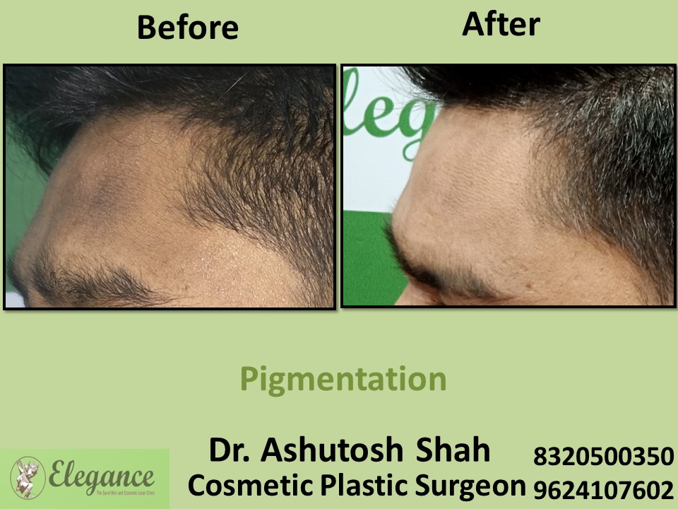 Pigmentation Treatment, Skin Treatment in Adajan, Surat