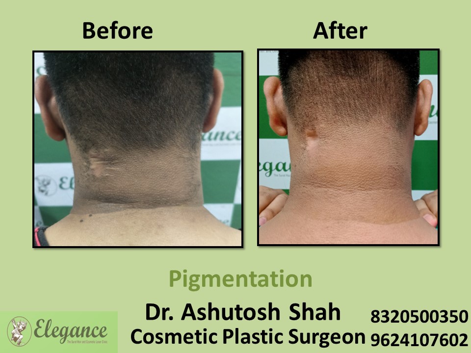 Pigmentation Treatment, Skin Treatment in Piplod, Surat