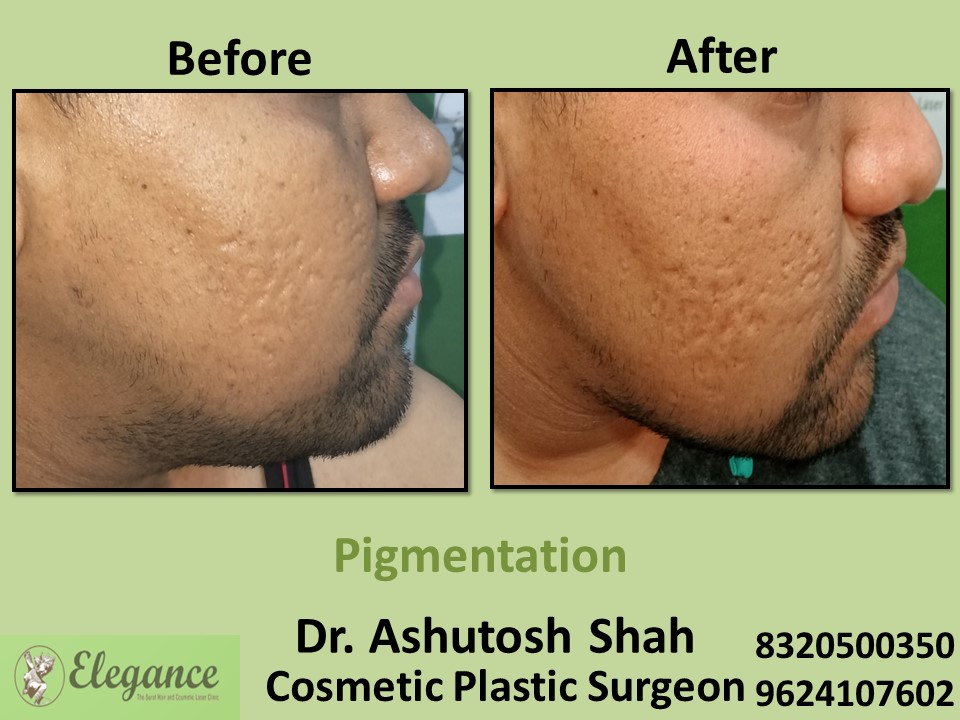 Pigmentation Treatment, Skin Treatment in Surat