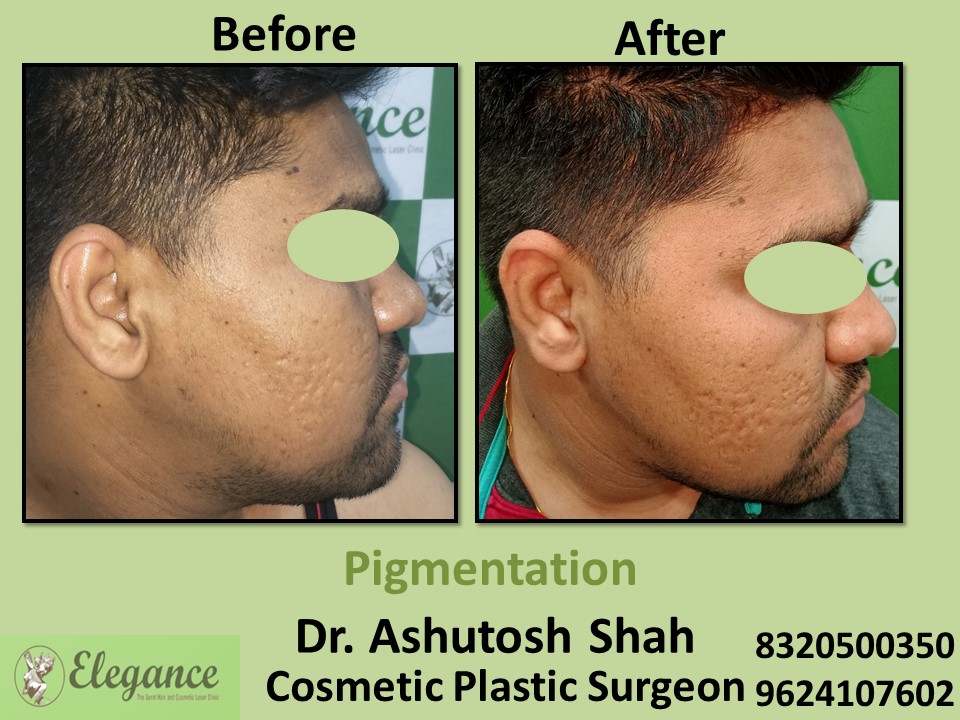 Pigmentation Treatment, Skin Treatment in Udhna, Surat