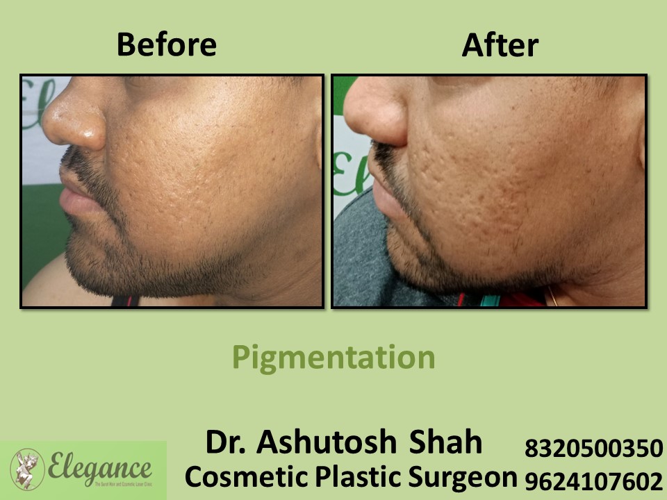 Pigmentation Treatment, Skin Treatment in Vesu, Surat