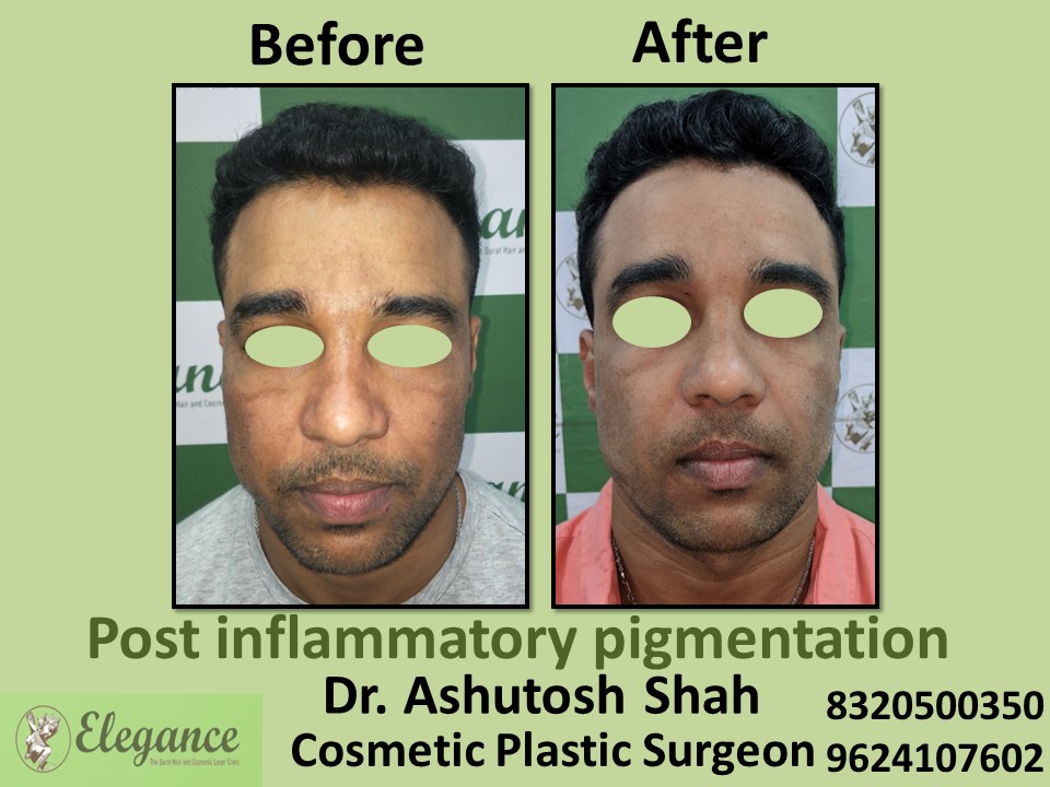 Post Inflammatory Pigmentation, Pigmentation Treatment in Vesu, Surat