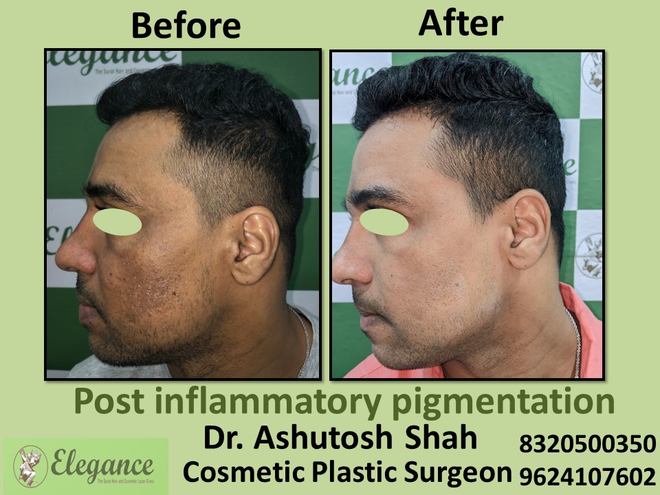 Post Inflammatory Pigmentation, Pigmentation Treatment in Piplod, Surat