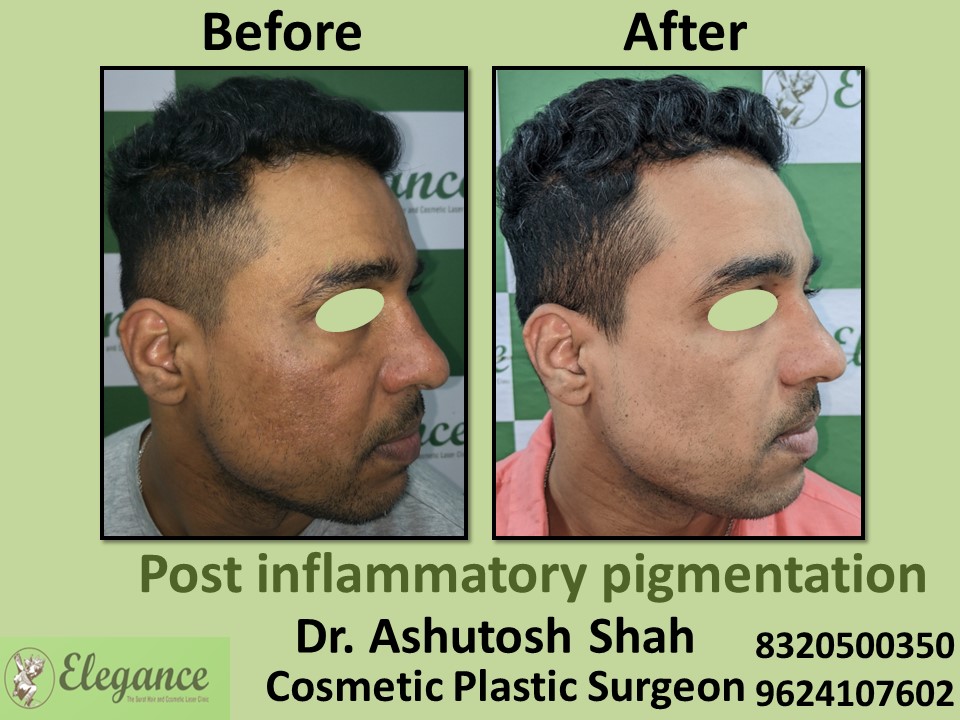 Post Inflammatory Pigmentation, Pigmentation Treatment in Athwagate, Surat