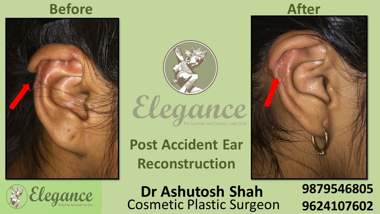 Post Accident Ear Reconstruction in Olpad, Piplod, Vesu, Bhatar, Surat
