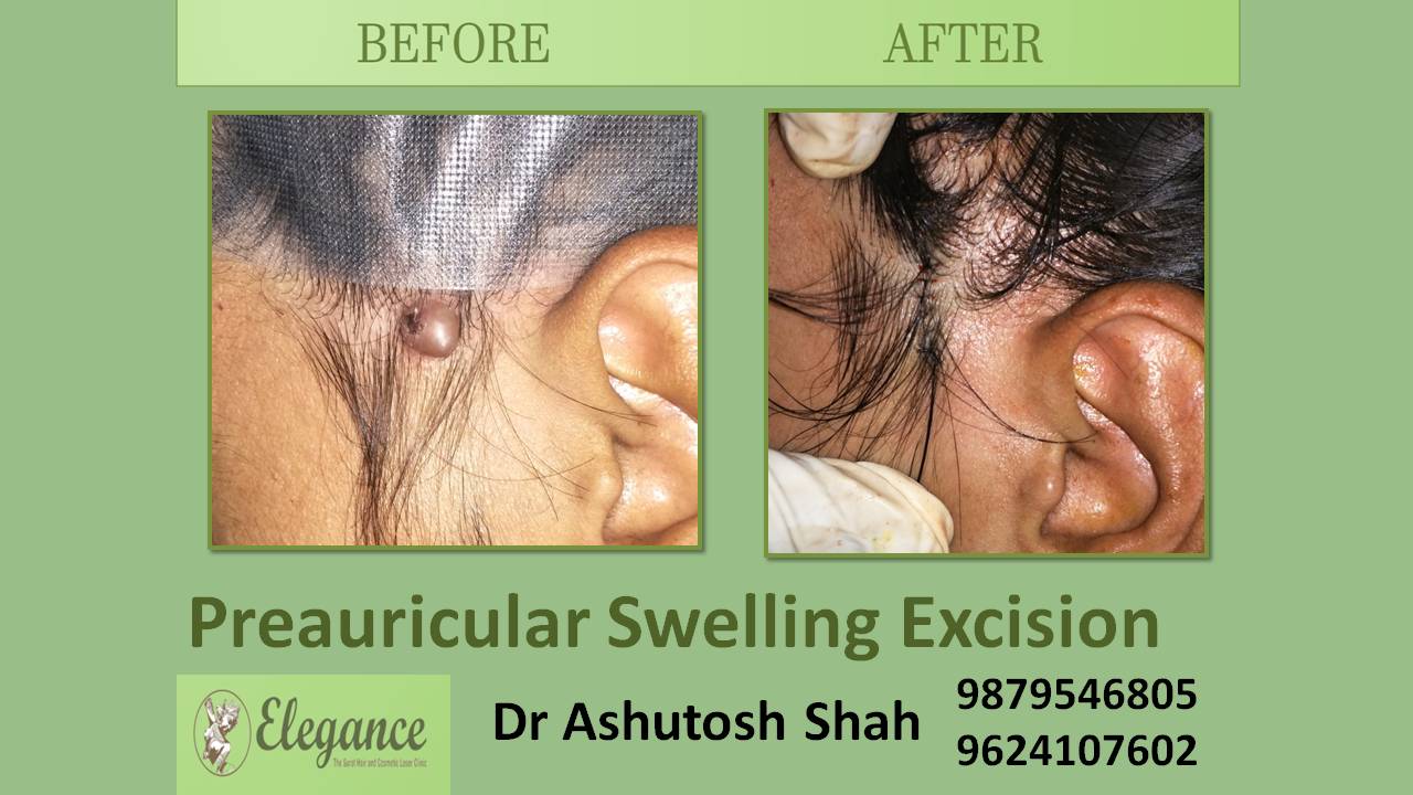 Preauricular Swelling Excision In Junagadh, Gujarat, India
