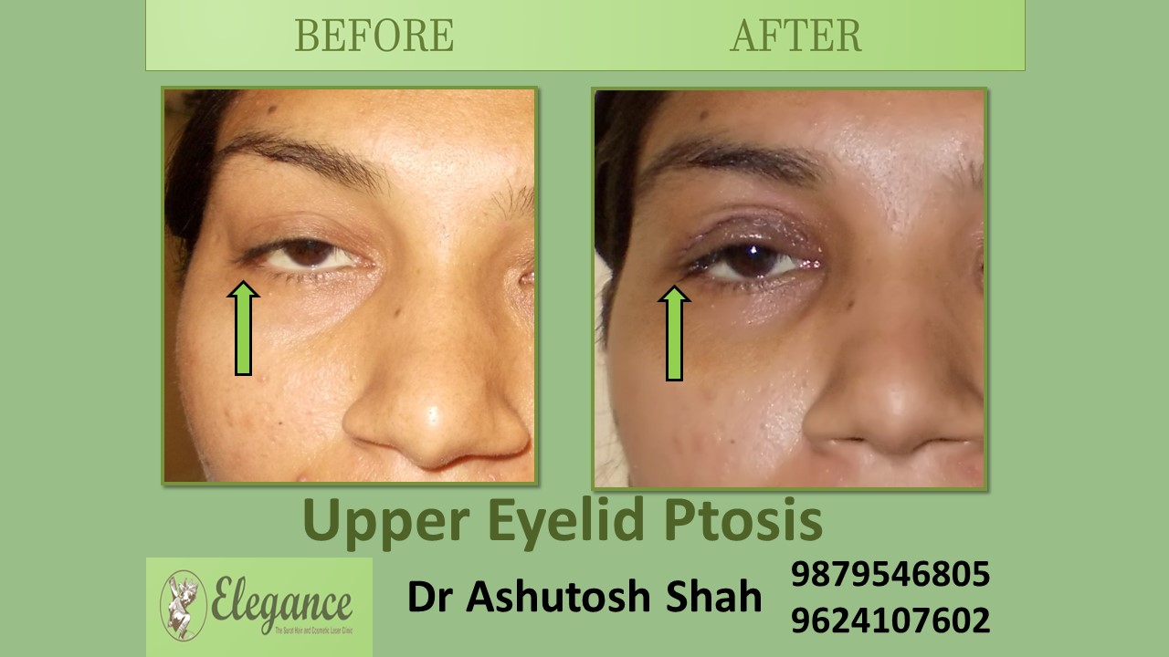 Cosmetic Ptosis Surgery in Surat, Gujarat (India)