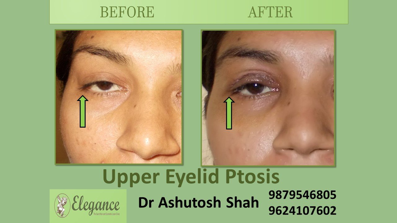 Ptosis Correction In Surat, Gujarat, India