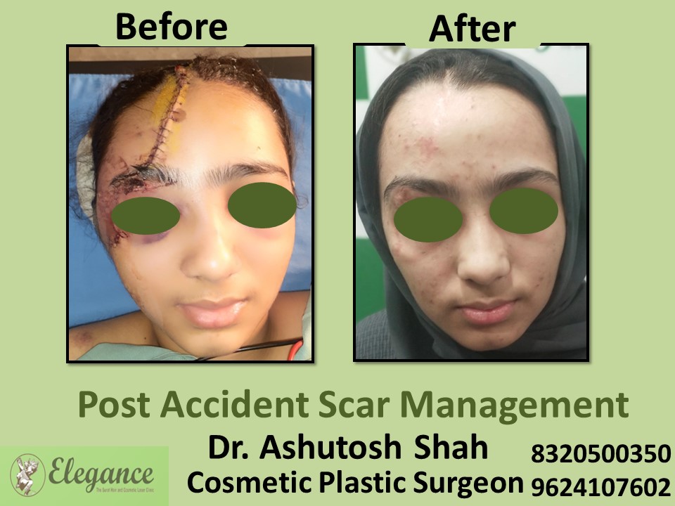 Post Accident Scar Management in Surat