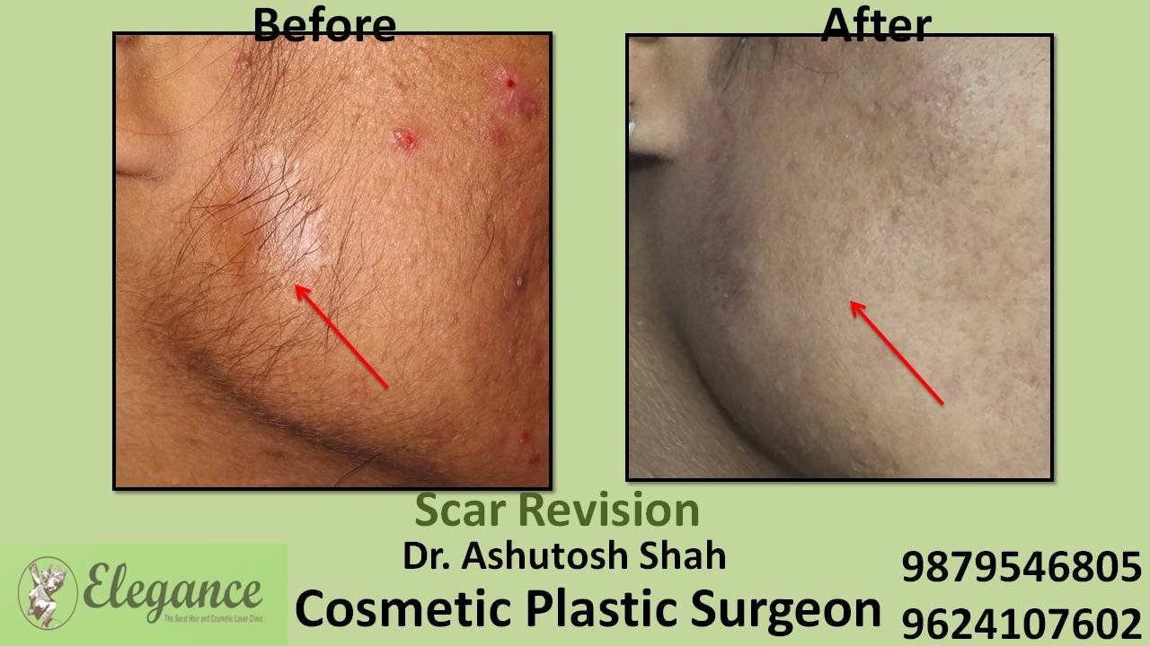 Scar Revision In Surat, Gujarat, India