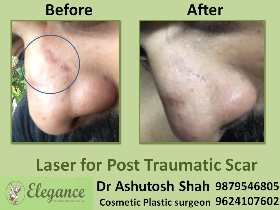Laser For Post Traumatic Scar Surgery In Surat, Gujarat, India