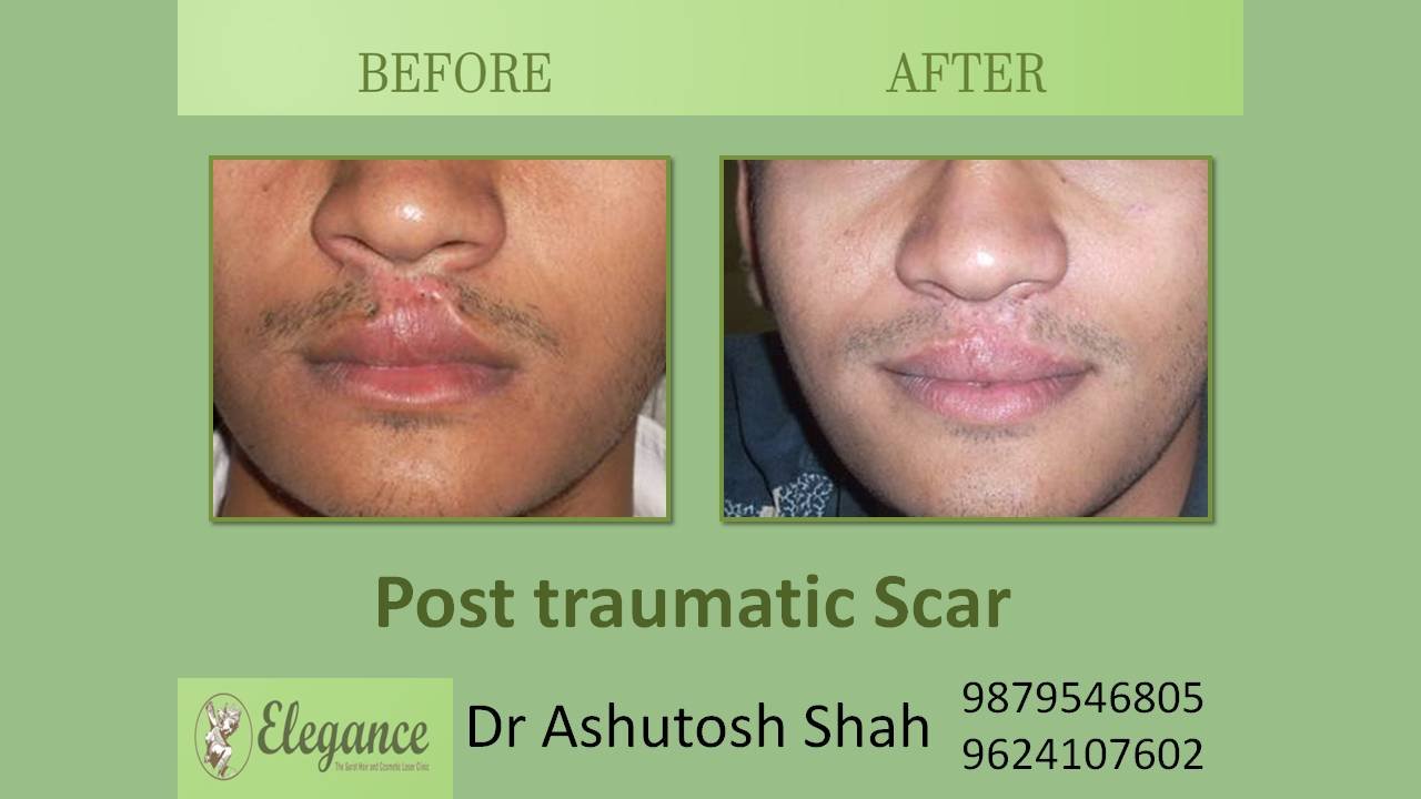 Post Trumatic Scar In Ahmadabad, Gujarat, India