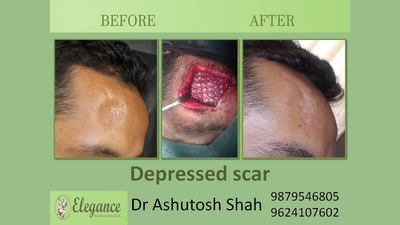 Depressed Scar Surgery in Surat, Gujarat, India