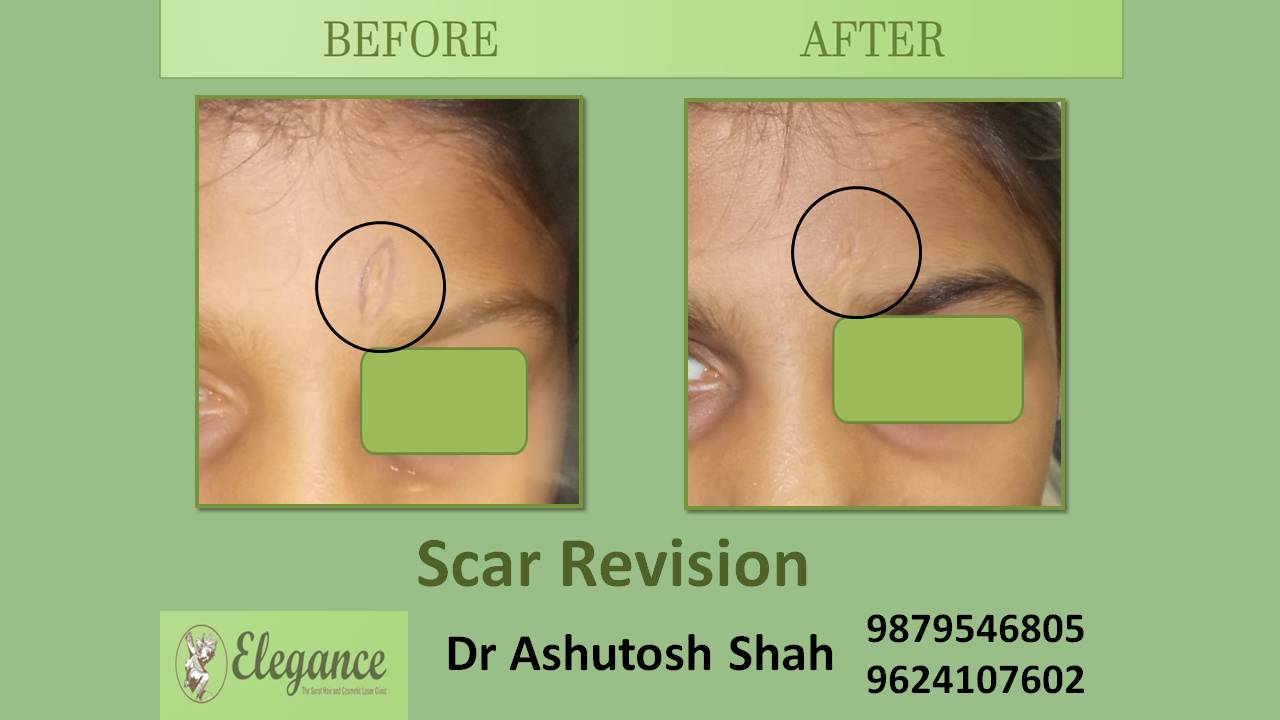 Scar Excision In Vadodara, Gujarat, India
