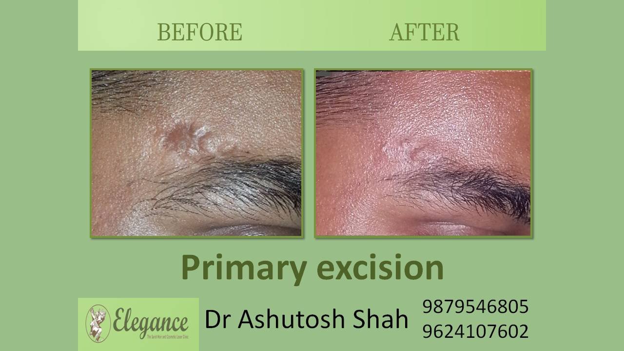 Scar Excision In Valsad, Gujarat, India