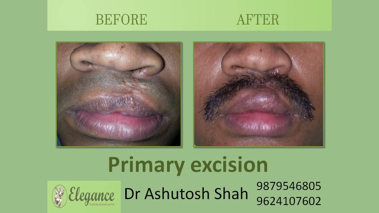 Scar Excision In Ankleshwar, Gujarat, India