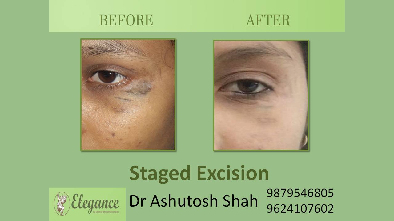 Scar Excision In Baruch, Gujarat, India