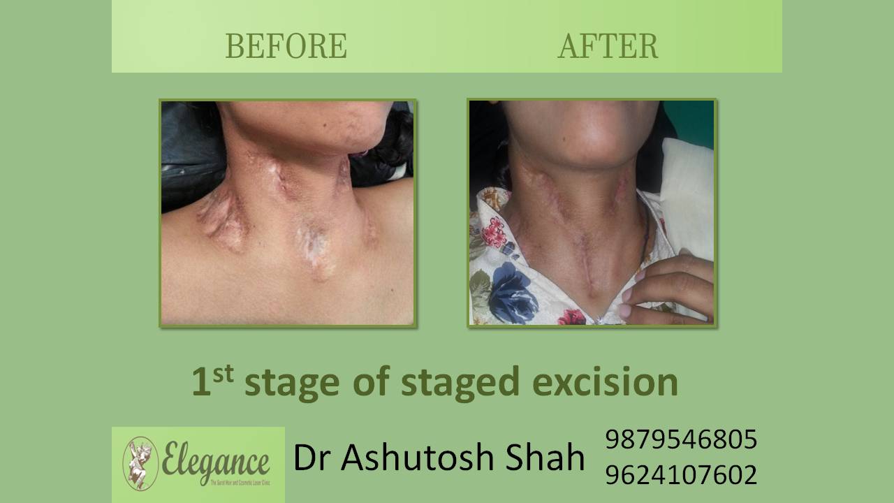 Scar Excision In Vyara, Gujarat, India