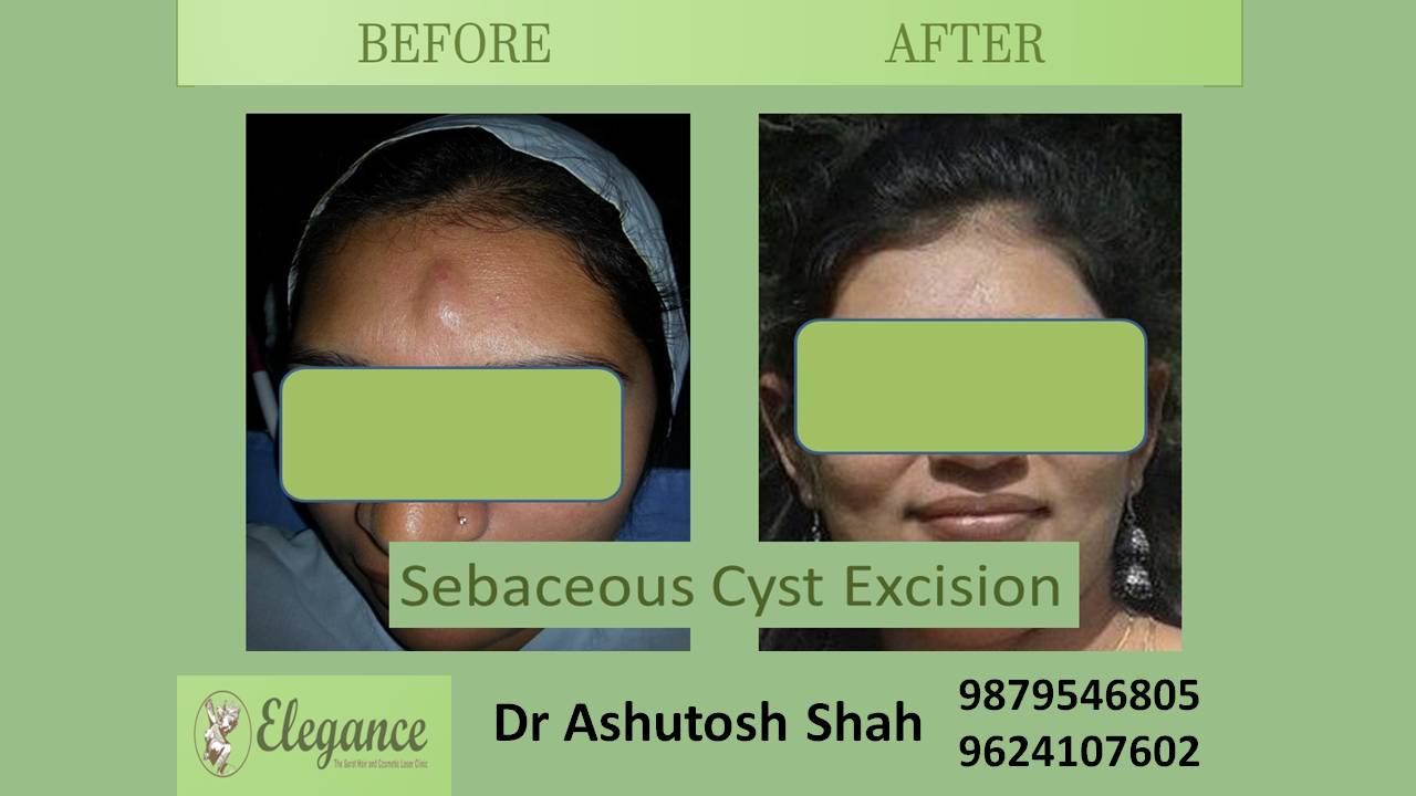 Sebaceous Cyst In Valsad, Gujarat, India