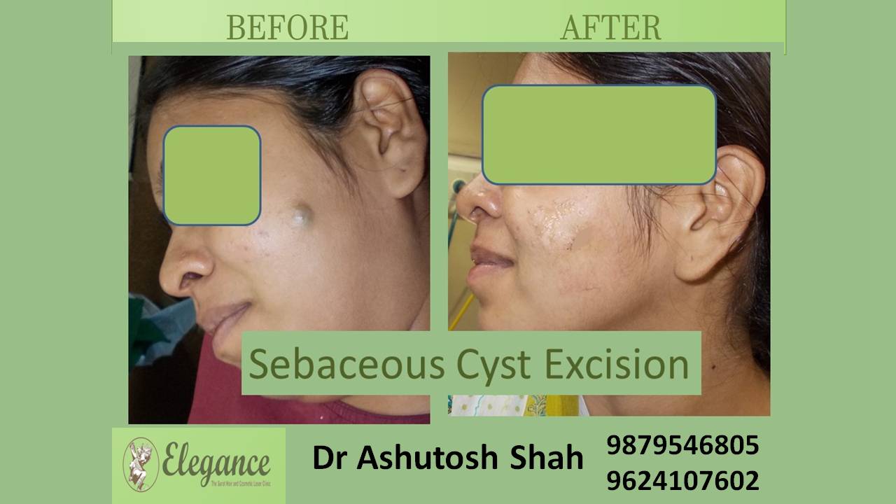 Sebaceous Cyst In Ankleshwar, Gujarat, India