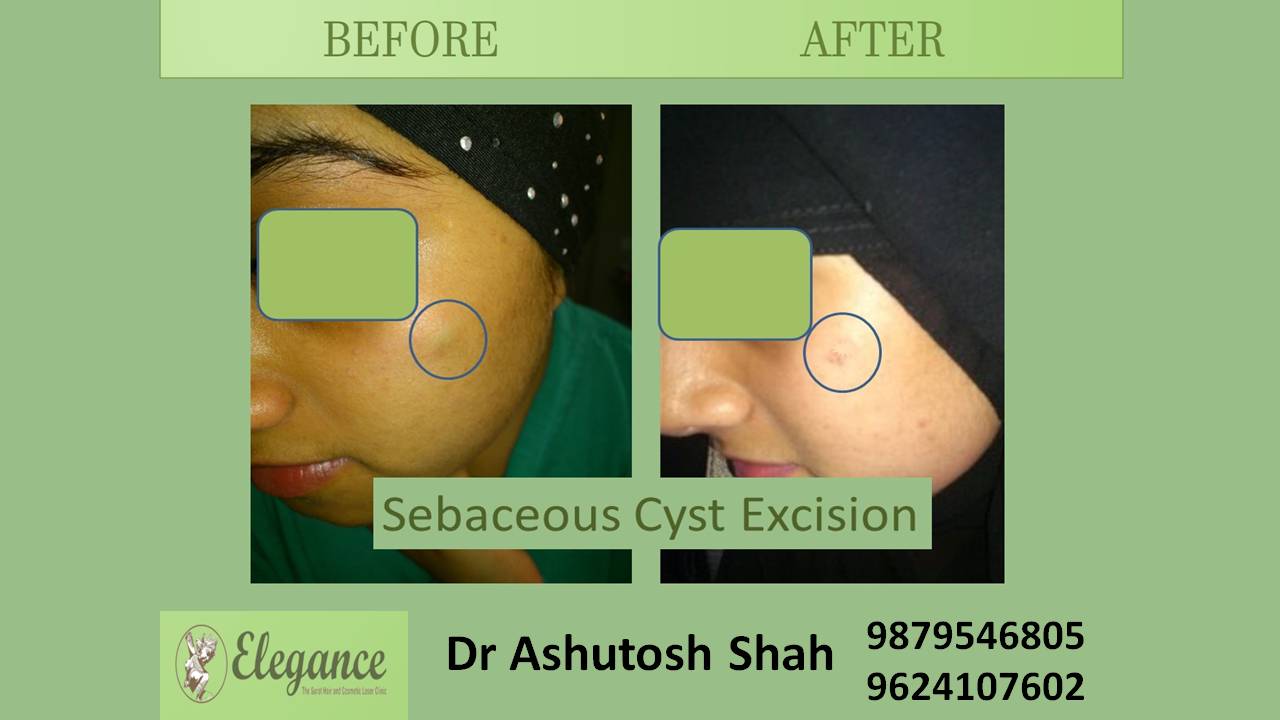Sebaceous Cyst In Bardoli, Gujarat, India