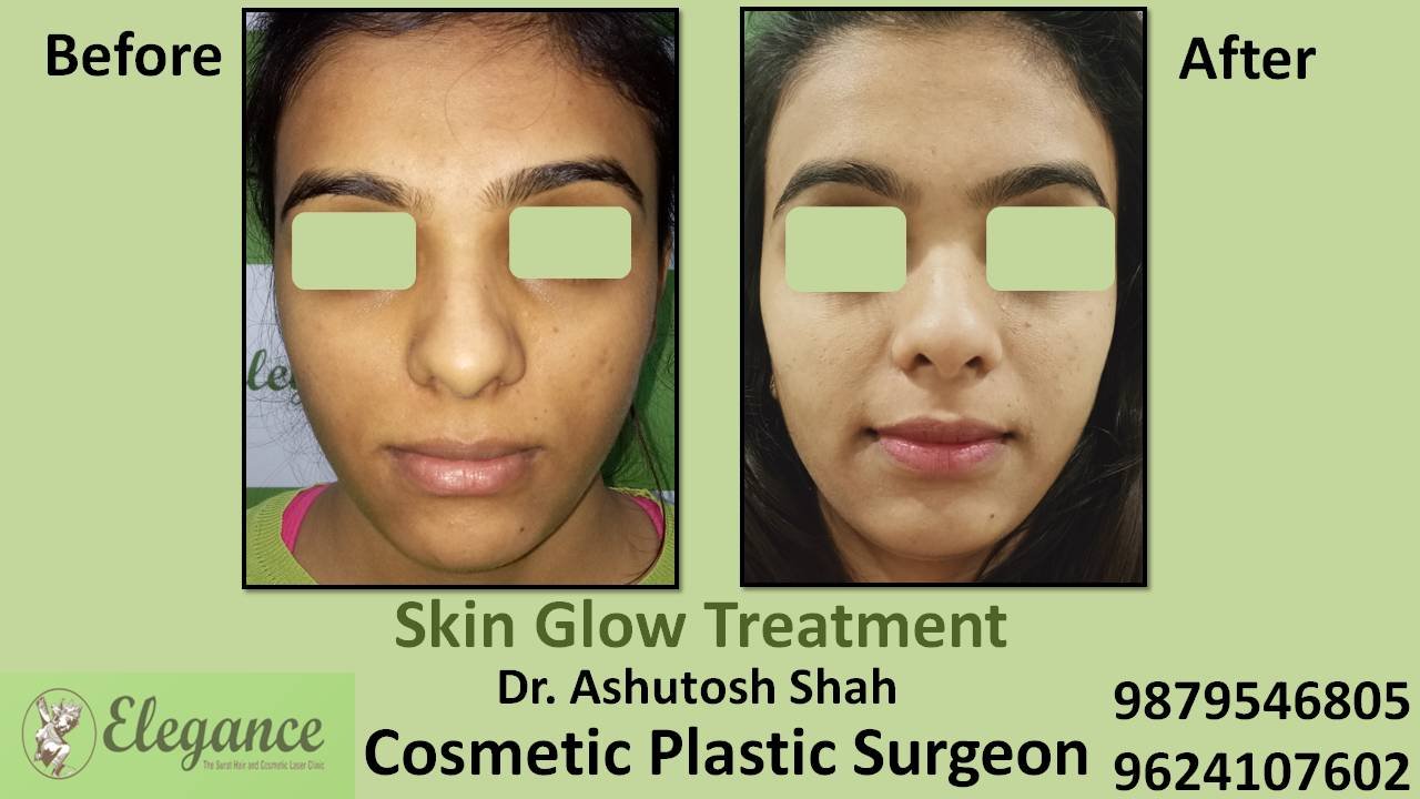 Facial Glow Oxygeneo Treatment in Surat, Gujarat (India)