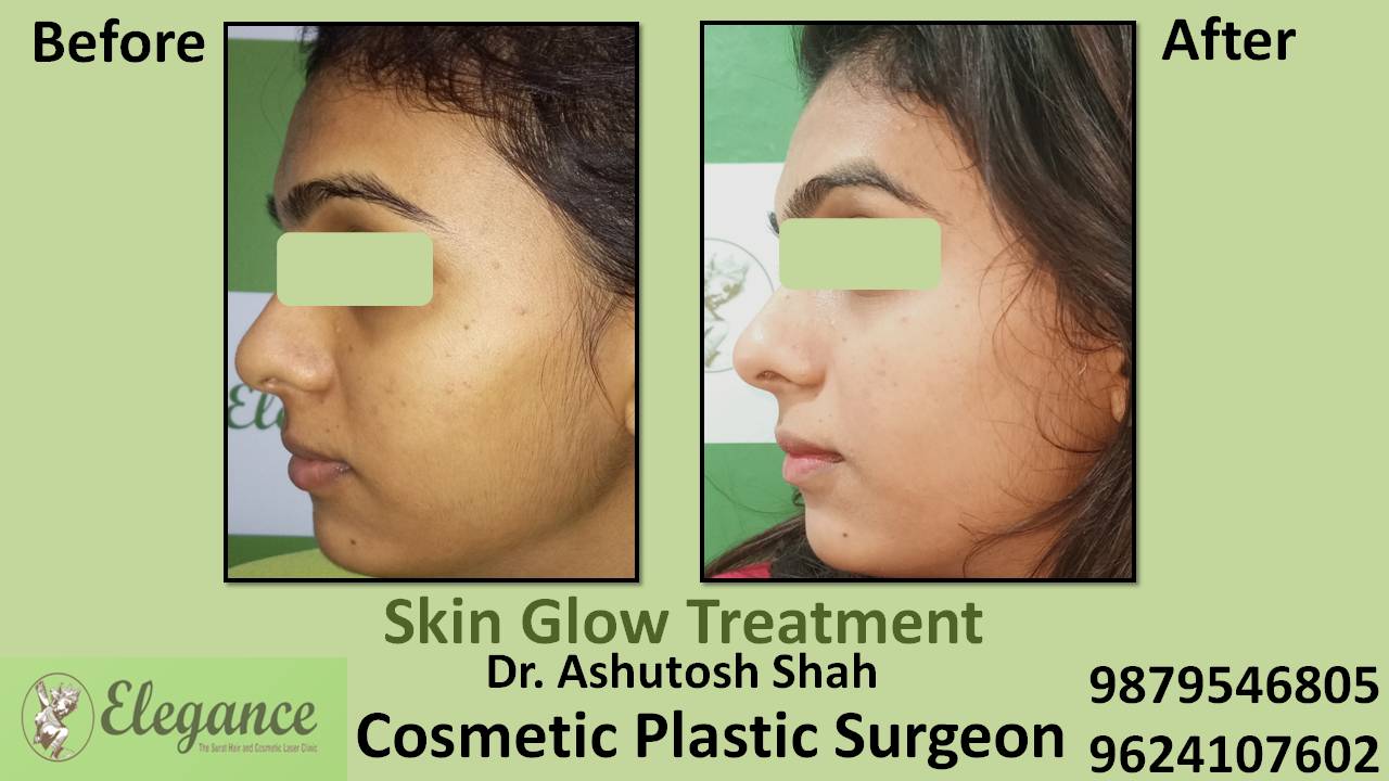 Skin Glow Treatment In Vapi, Gujarat, India