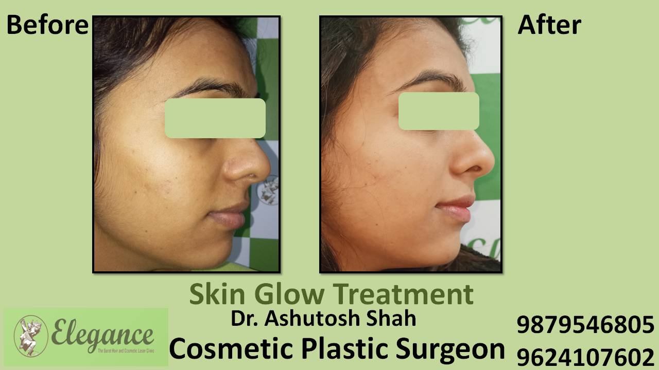 Skin Glow Treatment In Valsad, Gujarat, India