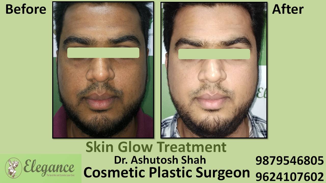 Facial Glow Oxygeneo Treatment in Surat, Gujarat (India)