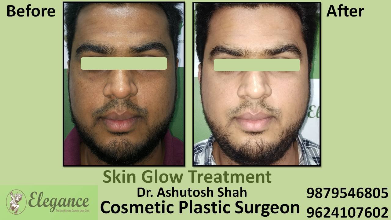 Facial Glow Treatment in Surat, Gujarat (India)