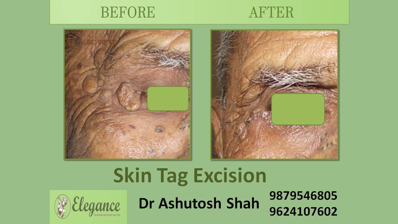 Skin Tag Excision In vadodara, Gujarat, India