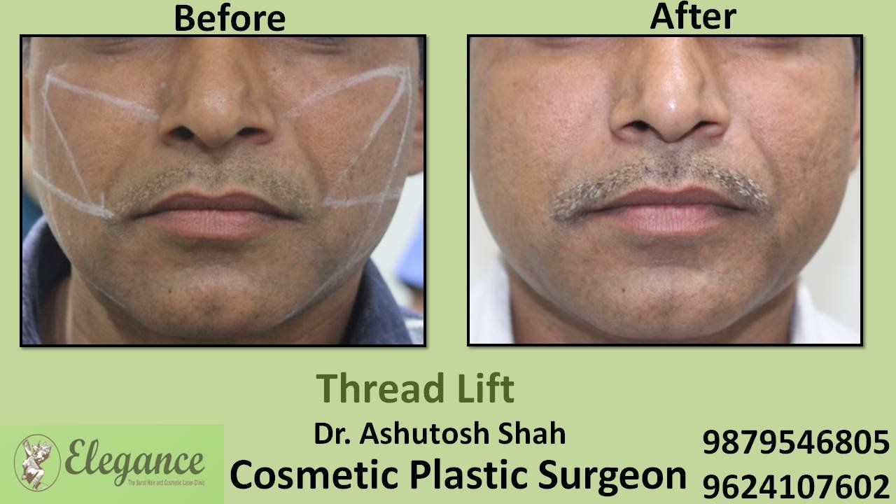 Thread Lift Cost In Surat, Gujarat, India