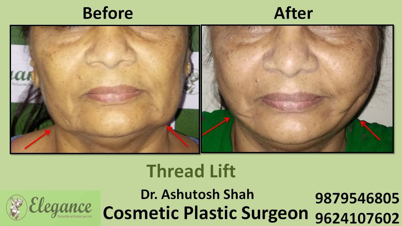 Thread Lift Surgery In Surat, Gujarat, India