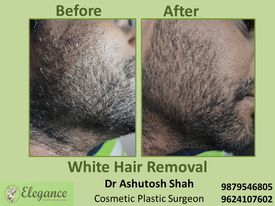 White Hair Removal, Beard Hair Removal in Vesu, Surat
