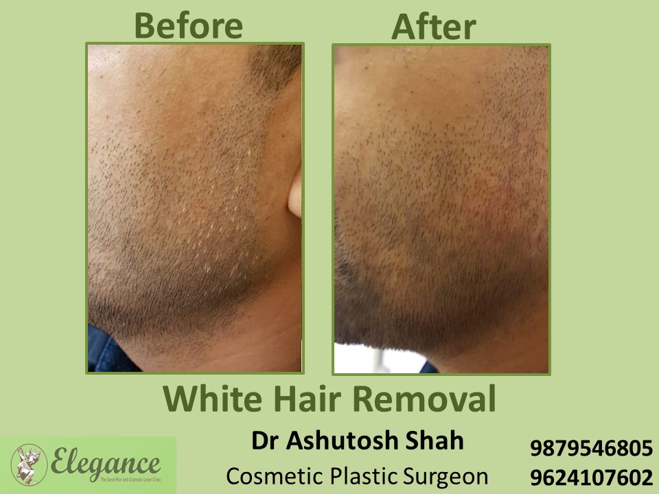 Beard Shaping, White Hair Removal in Piplod, Vesu, Surat