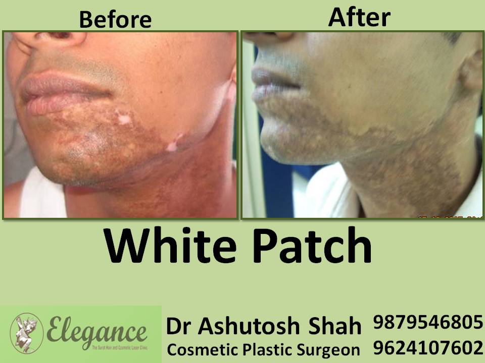 Treatment of White Patches in Surat, Gujarat (India)