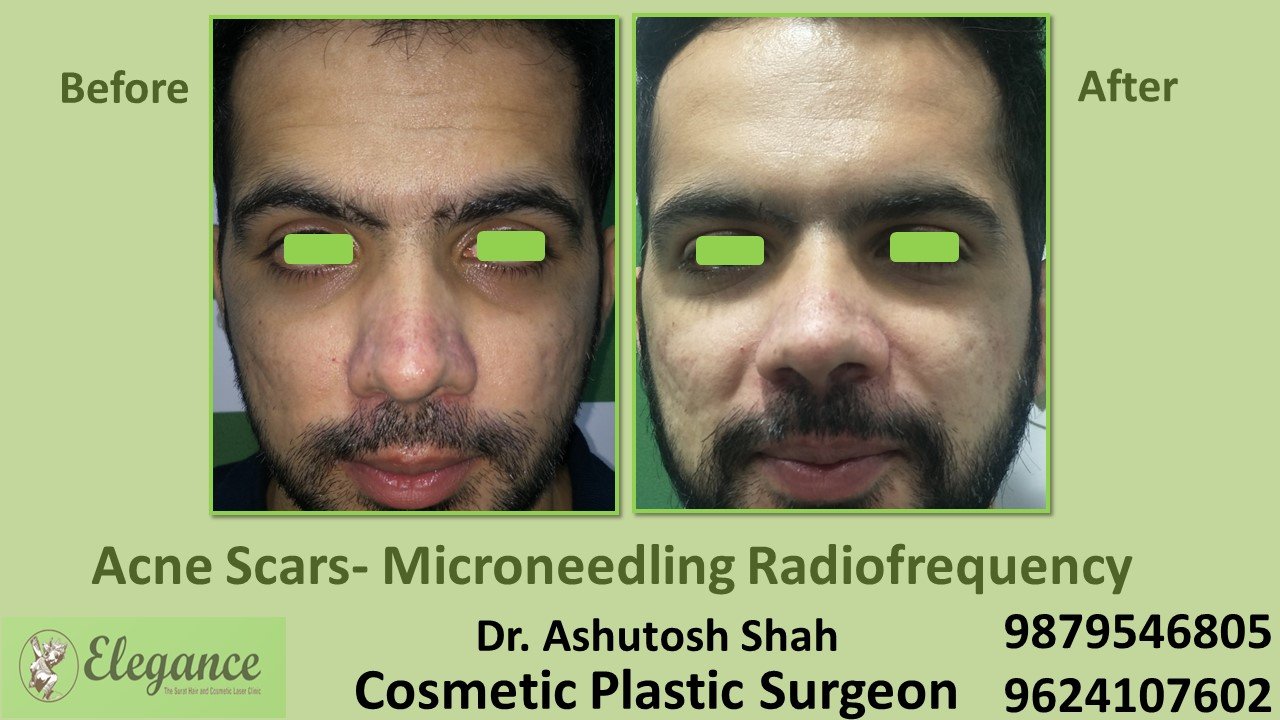 Facemakeover Treatment In Surat, Vapi, Bharuch, Gujarat.