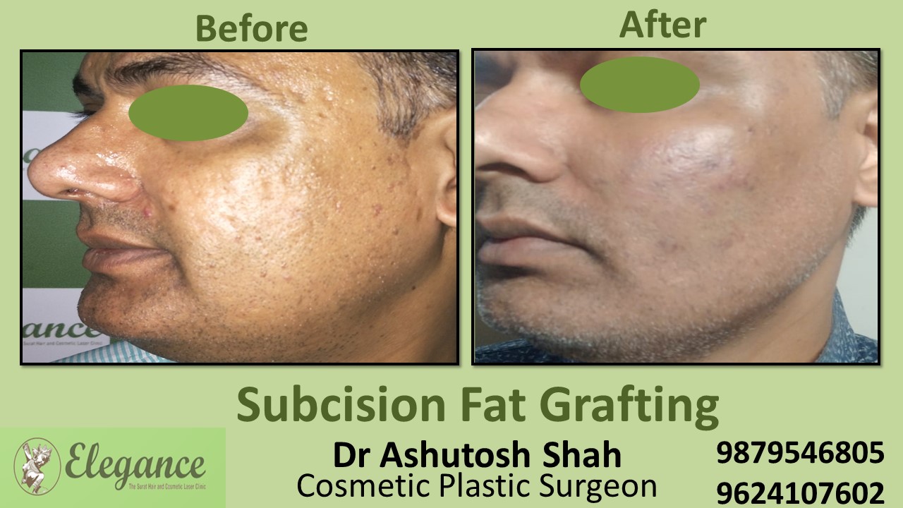 Fat Grafting Surgery Ahmedabad, Gujarat, India.