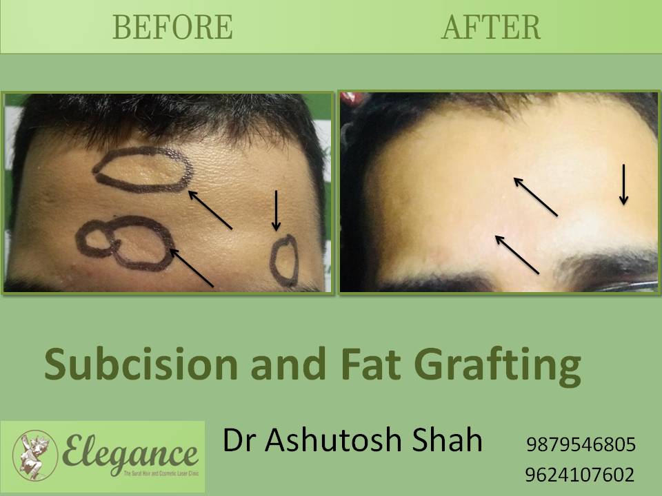 Fat Grafting Surgery in Surat, Gujarat, India.
