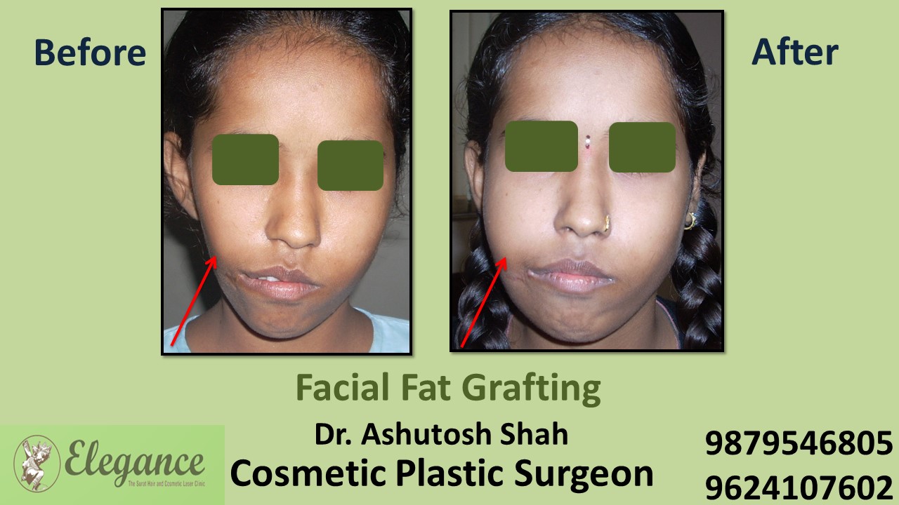 Fat Grafting Surgery Surat, Gujarat, India.